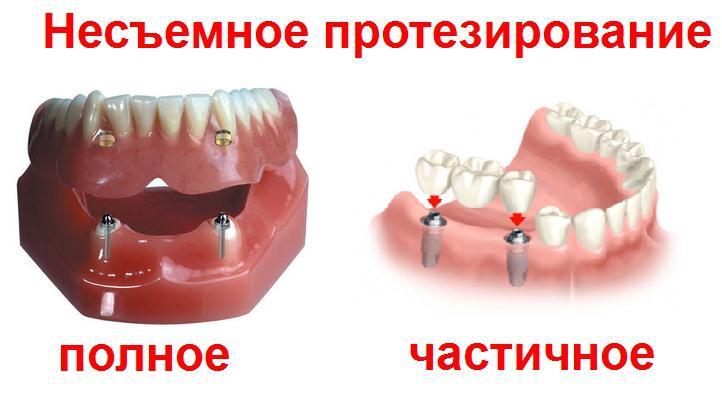 nesyemnoe protezirovanie zubov